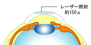 角膜：パーク近視手術